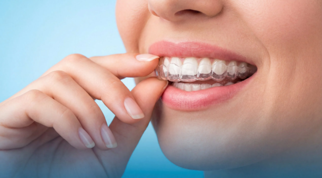 Clear Aligner Finance UK