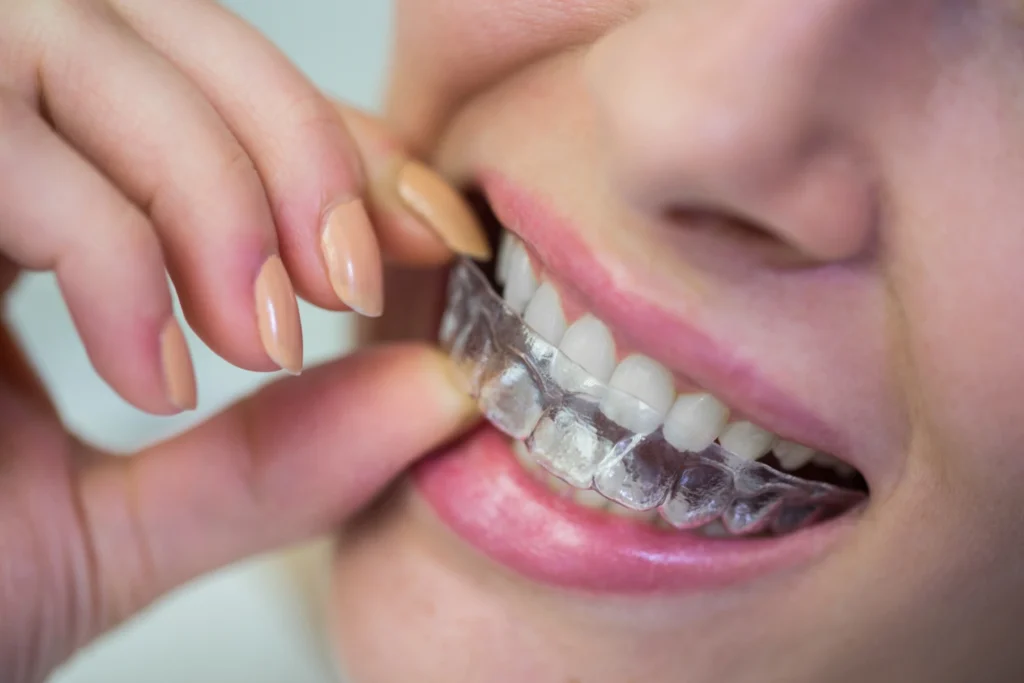 Clear Aligners Cost UK