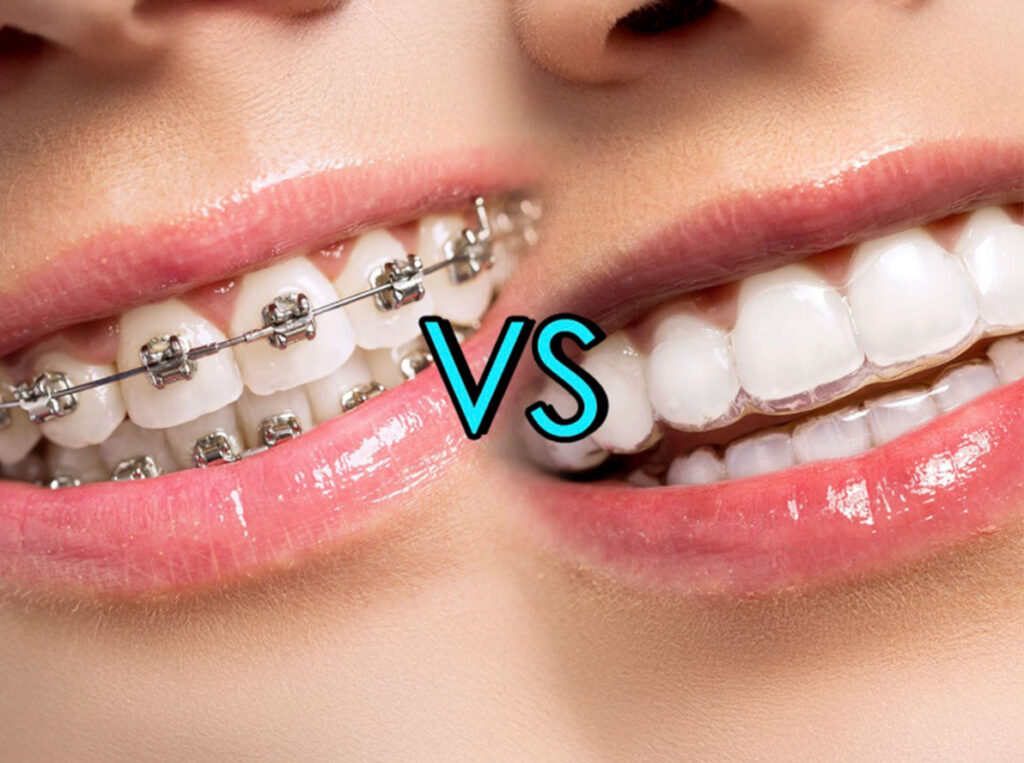 Clear Aligners vs Invisalign