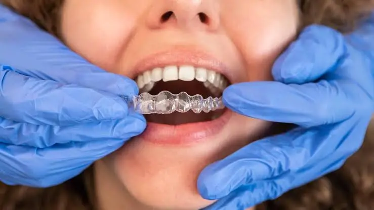 How long does Invisalign take