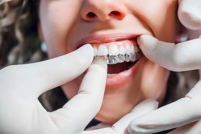 Invisalign Cost UK
