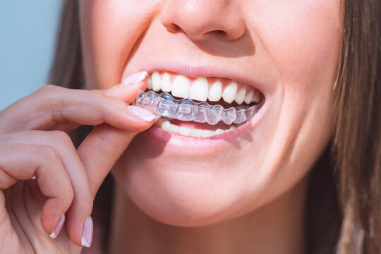 Aligner Fitting