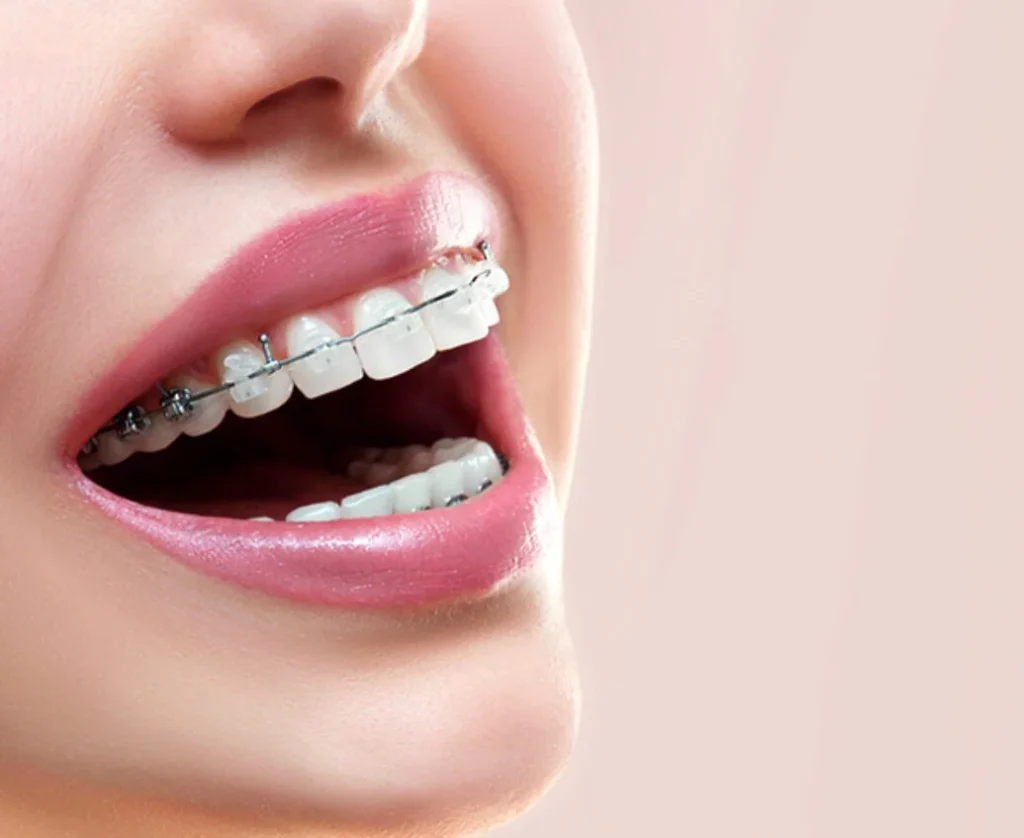 Invisalign in Charlton SE7