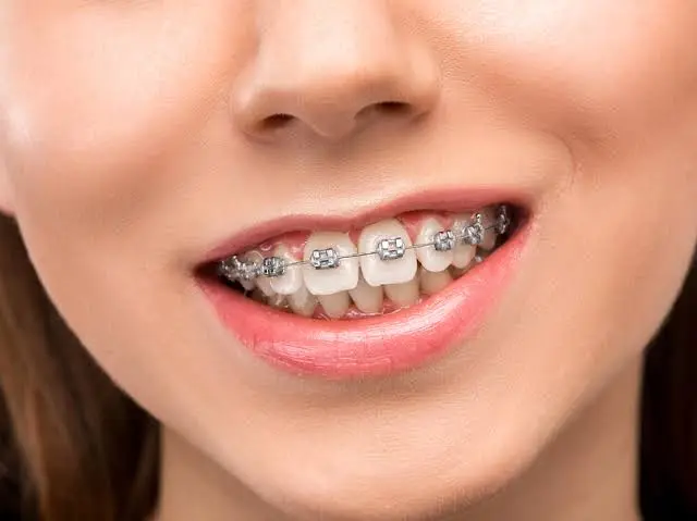 At Home Teeth Straightening