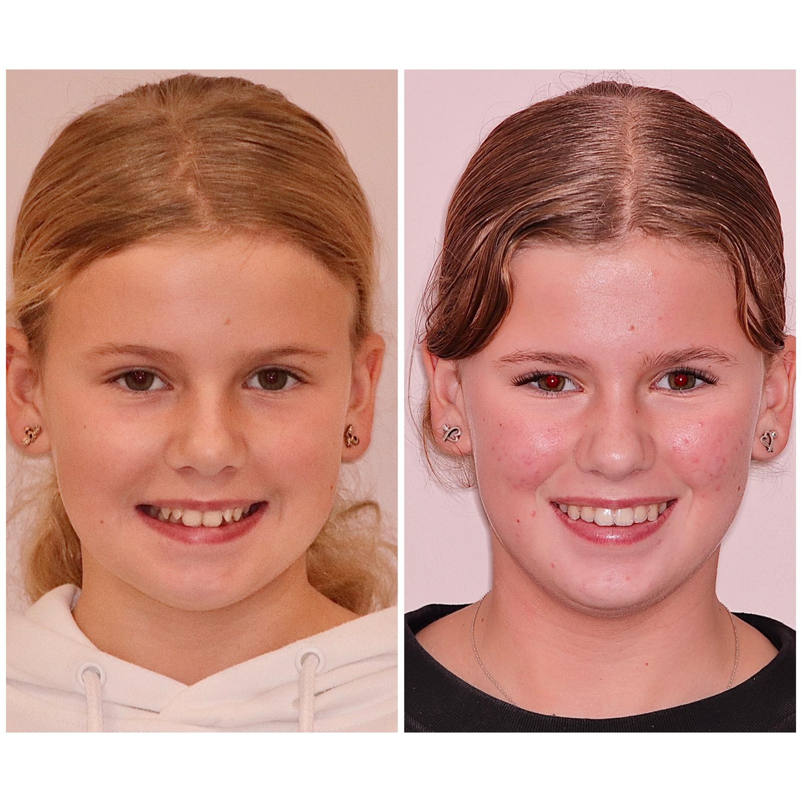 Sophie before and after Lucent Clear Aligners