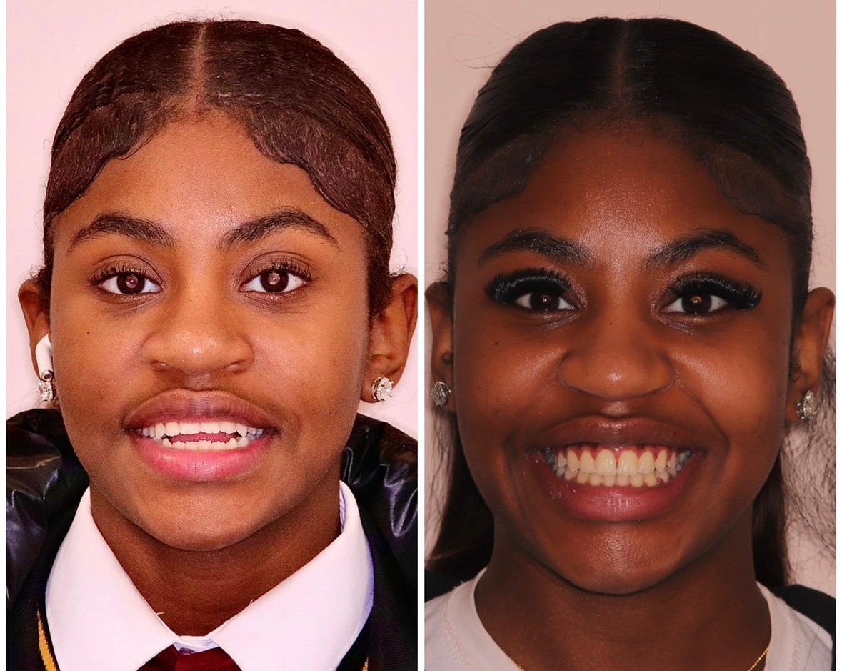 Emily before and after Lucent Clear Aligners