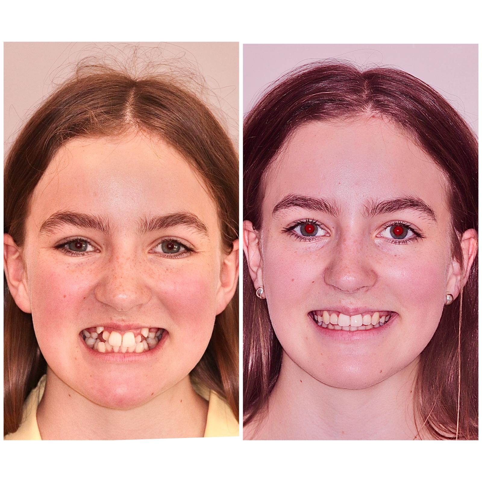 Olivia before and after Lucent Clear Aligners