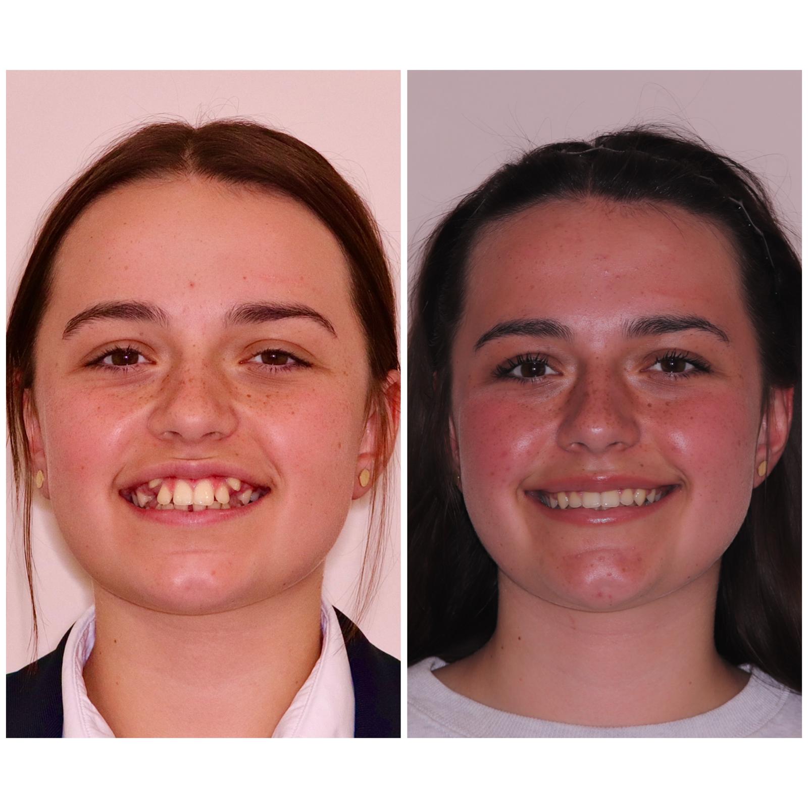 Charlotte before and after Lucent Clear Aligners