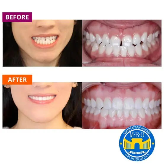 can clear aligners fix an underbite